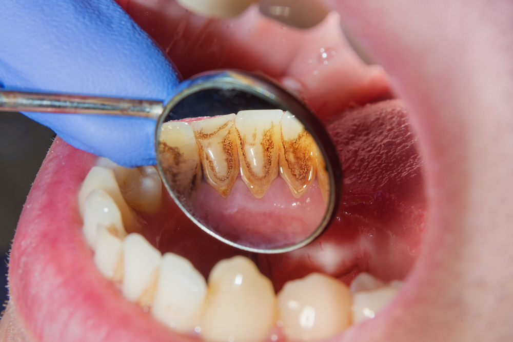 気になる歯の黒ずみ5つの原因と対処法 普段からの予防策とは おくちニュース